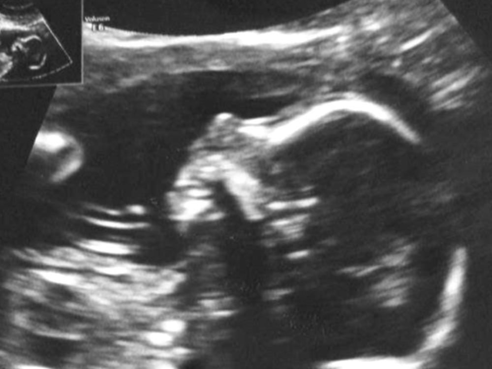 Ultrasound image of Olivia