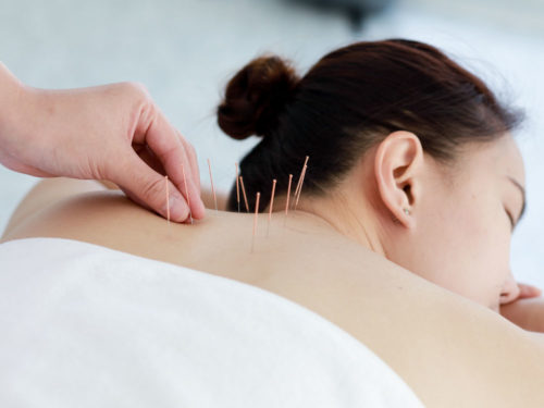 woman acupuncture